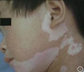 儿童白癜风治疗会复发吗,儿童白癜风